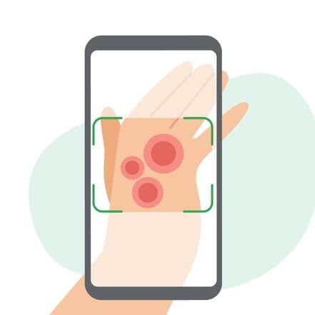 Asystent dermatologa AI Google smartfon oceni znamię